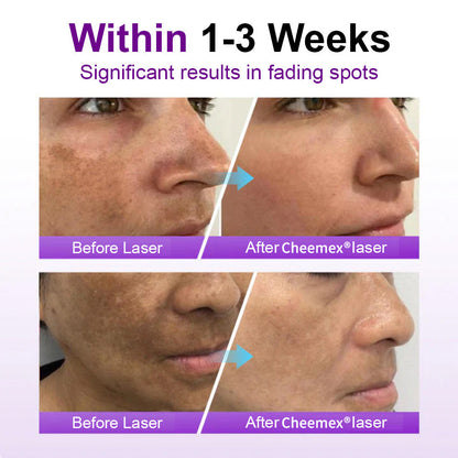 ✅𝐅𝐃𝐀-𝐀𝐏𝐏𝐑𝐎𝐕𝐄𝐃🌟Cheemex® 𝐒𝐩𝐨𝐭𝐄𝐫𝐚𝐬𝐞 𝐏𝐫𝐨𝐛𝐢𝐨𝐭𝐢𝐜 𝐒𝐡𝐢𝐞𝐥𝐝 𝐒𝐞𝐫𝐮𝐦 – Fades Dark Spots, Evens Skin Tone & Boosts Radiance✨